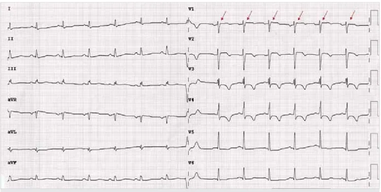 2. ÁBRA. Kamrai tachycardia 12 elvezetéses EKG-képe. 180/perc frekvenciájú széles QRS-tachycardia