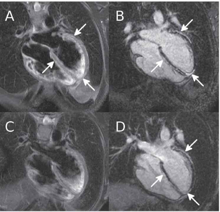 3. ÁBRA. Szív MR. Felső sorban: akut szív MR-vizsgálati képek; alsó sorban: kontroll szív MR-vizsgálat képei