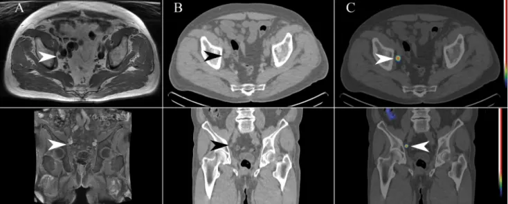 1. ábra 73 éves prosztatarákos férfi beteg, PSA: 1,2 ng/ml. Radikális prostatectomia után 2 évvel az emelkedett szérum-PSA alapján a betegség progresszióját  valószínűsítették