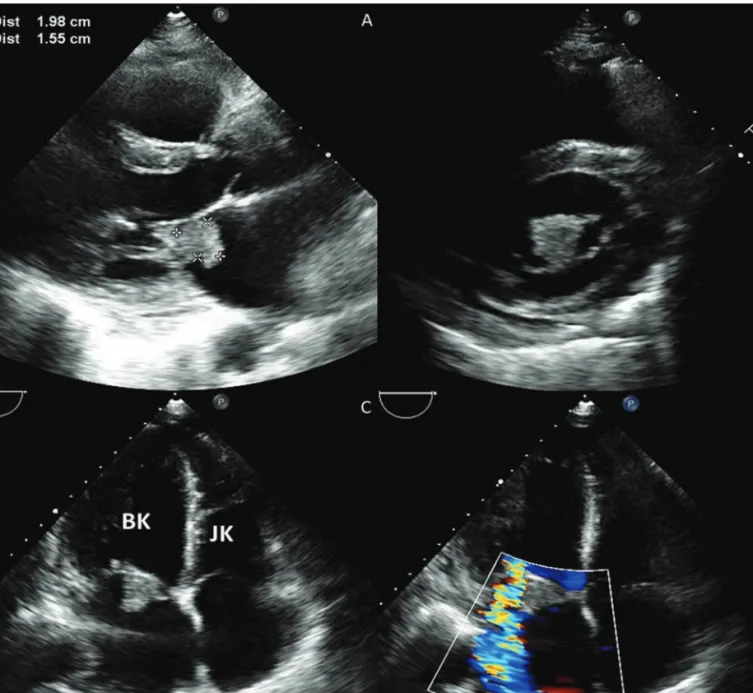 1. ÁBRA. Libman–Sacks-endocarditis transthoracalis echokardiográfiás képe. A mitralis mellső vitorlához kapcsolódó terime  jól vizualizálható parasternalis hossztengelyi (A) és rövidtengelyi (B) valamint csúcsi négyüregi nézetből (C) is