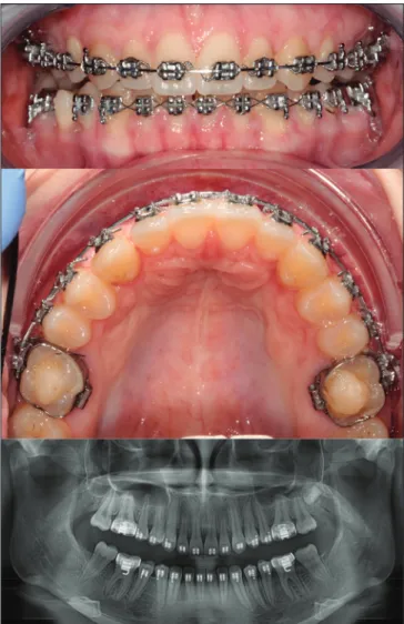 Figure 4: Gingivitis and pus formation are seen around the  palatinally positioned mini-screw