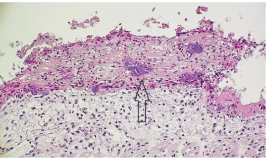 Fig. 7. Serofibrinous inflammation in the epicardium with clusters of bacteria (↑) in a goose