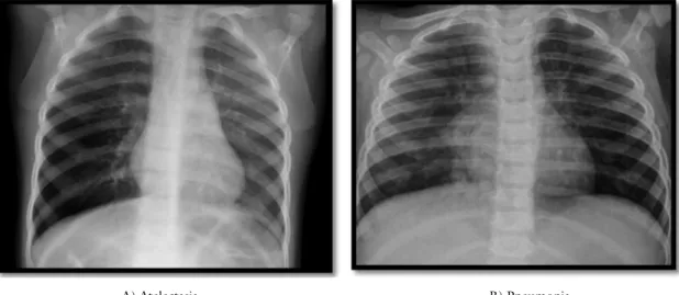 5. ábra A légúti aspiráció során észlelt mellkasi röntgenfelvétel eltérései