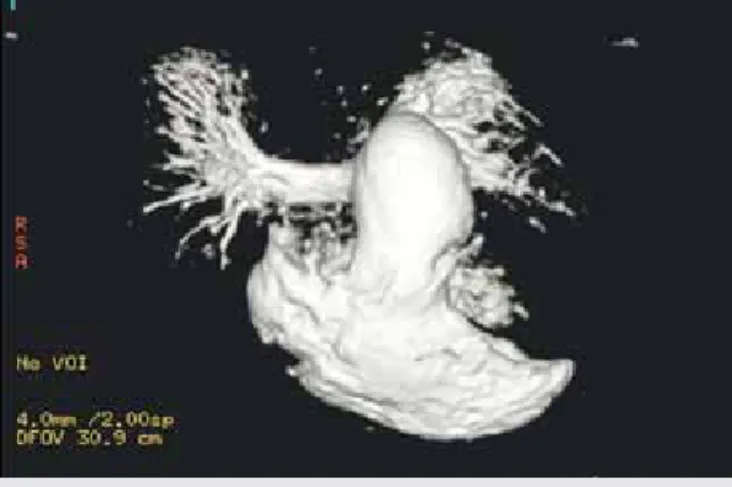 2. ÁBRA. MR-képen a tágult arteria pulmonalis törzs látható