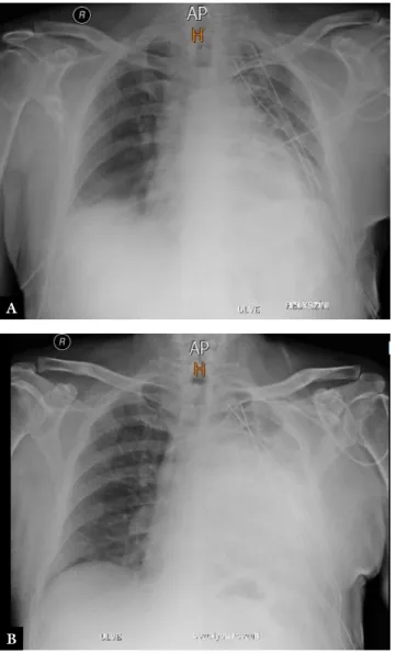 1. ábra A posztoperatív 1. (A) és 3. napon (B) készült mellkas-röntgen- mellkas-röntgen-felvétel