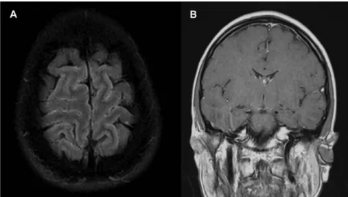 Figure 1. Magnetic resonance imaging. (A) Fluid attenuated inversion recovery shows sulcal hyperintensities, indicating protein leakage due to the disturbance of the blood – brain barrier