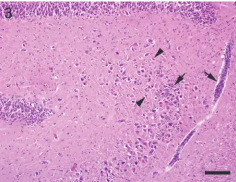 Fig. 3. Neuronal degeneration and infiltration with lymphocytes (arrows) in the cornu ammonis  (arrowheads) in limbic encephalitis