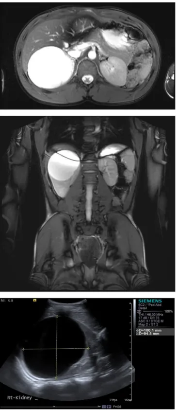 Fig. 11. Pre-operative imaging for patient 5 - MR Urogram and USS showing 8.4  9.6  9.2 cm cyst with no communication with the renal calyceal system and no solid components or associated vascularity.