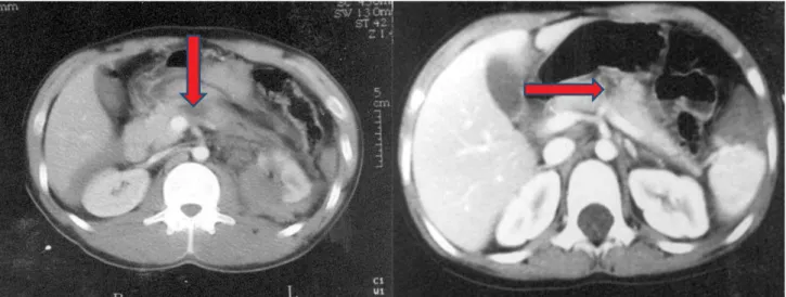 1–2. ábra A hasnyálmirigy-keresztmetszet felét meghaladó parenchymasérülések CT-képei