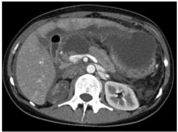 5. ábra Tompa hasi trauma kapcsán kialakult pancreas-transsectio CT- CT-képe egy 17 éves lánynál
