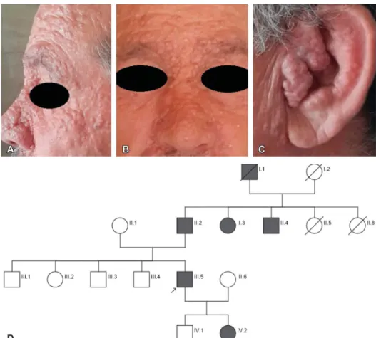 FIGURE 1. Clinical data of family with BSS. A–C, Multiple papules on the proband’s face, mostly around the nose, periorbital area, and ears