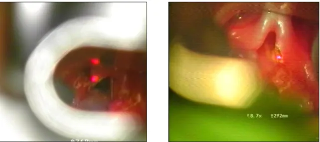 Figure 3. UDP laser aryepiglottoplasty (intraoperative pictures), wedge resection of the shortened aryepiglottic  fold (left) and resection of the edges of the epiglottis (right)