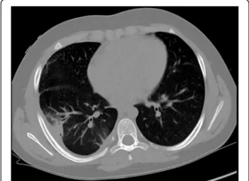Fig. 1 Computed tomography picture of pleuropneumonia in Case 2