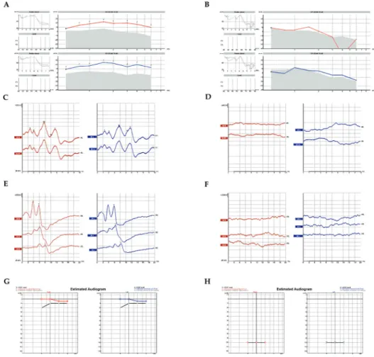 Figure 1. Objective clinical measures of the auditory function in patients with hearing loss