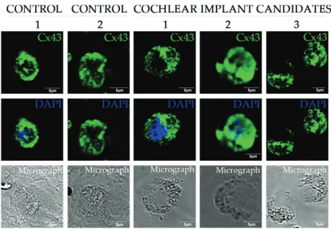 Figure 3. Pattern  of  connexin26  ion  channels  on  blood  cells  of  patients  expecting  cochlear  implantation