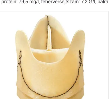 1. ÁBRA. Pericarbon Freedom Stentless aortaműbillentyű  szerkezete ex vivo (gyártó cég engedélyével megjelent ábra)