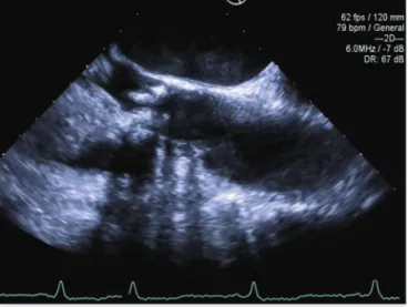 2. ÁBRA. Az első transoesophagealis echokardiográfia  so rán (aortabillentyű felső oesophagealis hossztengelyi  metszet, 110 fok) végdiasztoléban jól látható az  aortabil-lentyű bal kamra felé eső oldalán elhelyezkedő  vegetáció-nak imponáló képlet