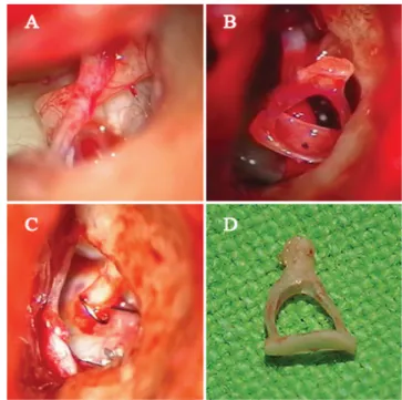 1. ábra A stapedectomia műtéti megoldásának intraoperatív ábrázolása A: A hallójárati bőrcső leemelve a csontos hallójáratról, így  be-tekintést nyerünk a középfülbe