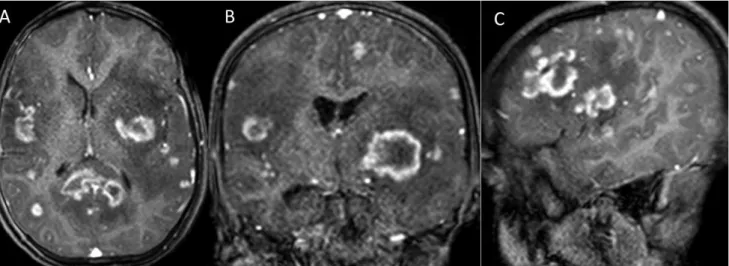 1. ábra DOCK8-deficientiában szenvedő 10 éves leány kontrasztanyagos axialis (A), coronalis (B) és sagittalis síkú (C), T1-súlyozott koponya-MR-felvétele