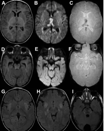 3. ábra 5 hónapos, autoszomális domináns akut nekrotizáló encephalo- encephalo-pathiában (ANE1) szenvedő kisfiú koponya-MR-felvétele