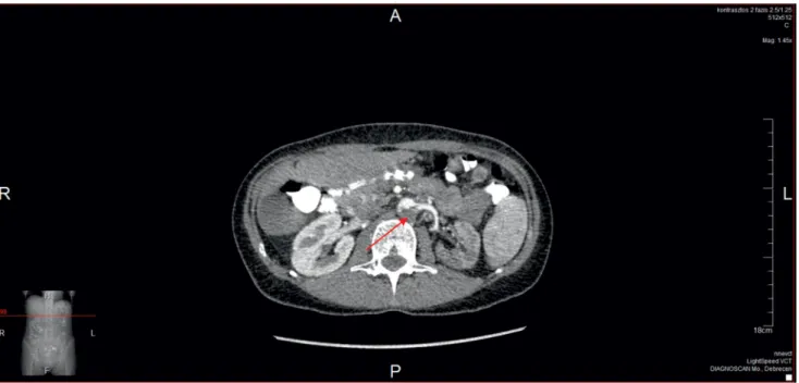 2. ábra Kontrasztos hasi CT-vizsgálat (2015. 04. 07.): artériás thrombosis az aorta abdominalis szakaszán, mely beterjed a bal arteria renalisba