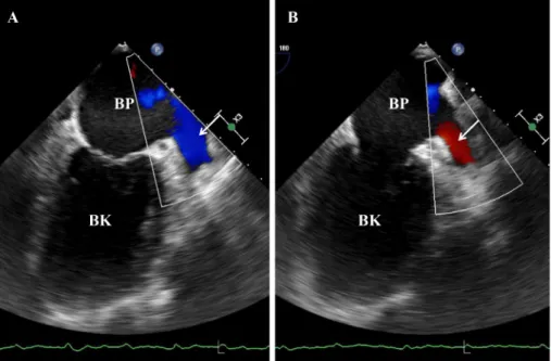 4. ábra Színes Dopplerrel ábrázolható kamrai szisztoléra eső telődési beáramlás (A) és pitvari szisztoléra (kamrai késő diasztoléra) eső kontrakciós kiáramlás  (B) kétdimenziós transoesophagealis echokardiográfia során (l