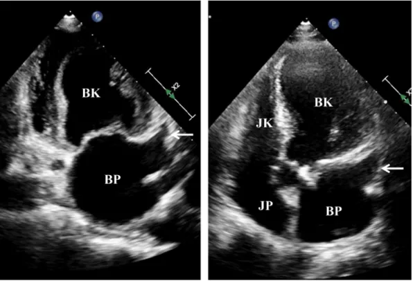 9. ábra A bal pitvari fülcse, a bal pitvar és a bal kamra metszete (A), valamint a bal pitvari fülcse a bal pulmonalis artériából ábrázolva (B) kétdimenziós intra- intra-cardialis echokardiográfia során (l