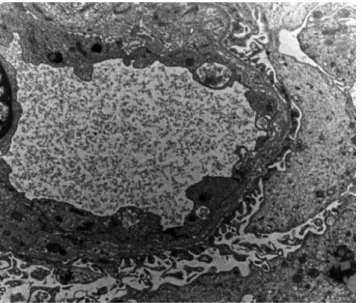 2. ábra Krónikus antitestmediált rejekció. A glomerularis bazálmemb- bazálmemb-rán rétegződését látjuk fény- és elektron-mikroszkóposan (saját  anyag)