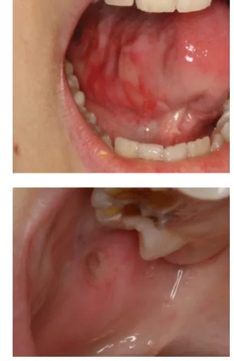 1. ábra Oralis mucositis a nyelv ventralis felszínén, illetve a buccalis mu- mu-cosa hátsó harmadában