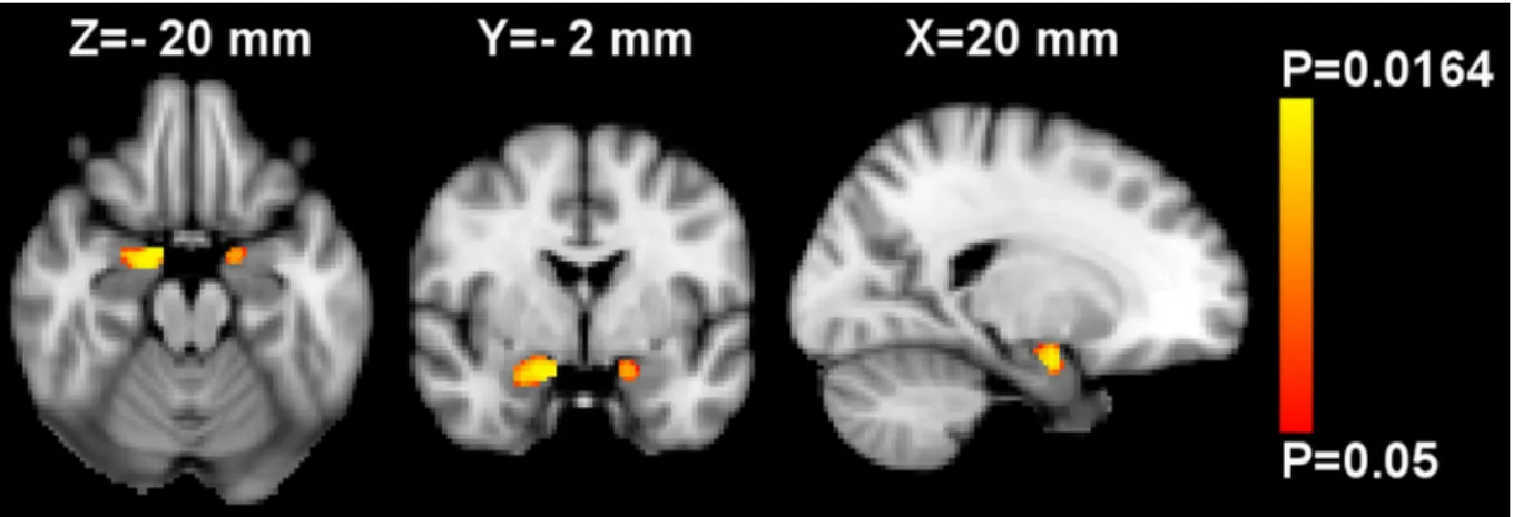 Fig 1. Region of interest voxel-based morphometry analysis of gray matter mass (GMM) in the bilateral mask of amygdala