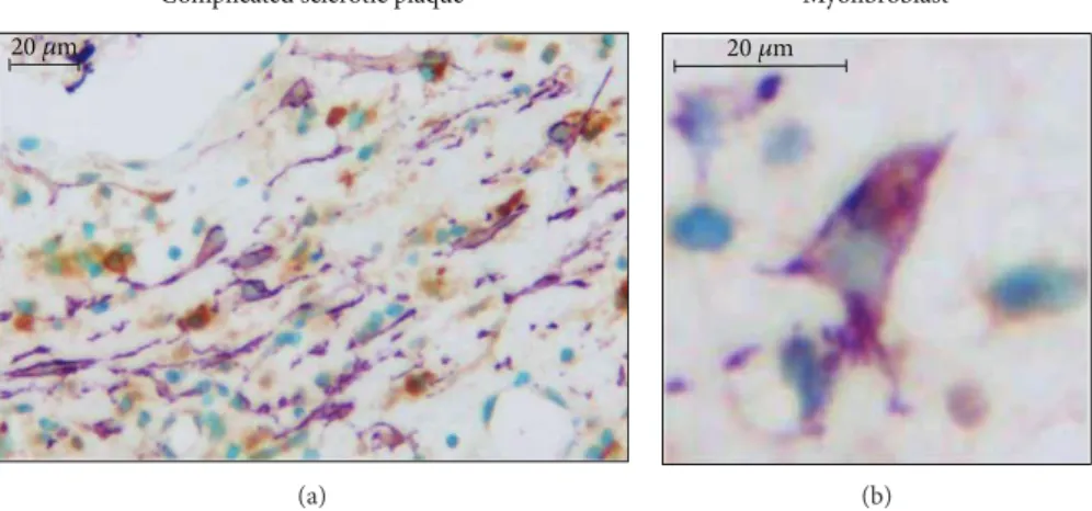 Figure 3: CSE expression in activated myoﬁbroblasts in a cellular area of a complicated sclerotic plaque