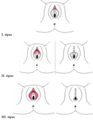 ábra mutatja be. Az FGM III. típusa esetén gyakori a  nagyon fájdalmas és elhúzódó (1–2 hétig tartó)  menst-ruációs vérzés, emiatt fájdalomcsillapítókra is szükség  lehet