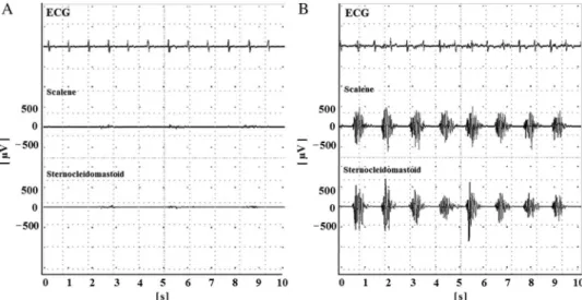 Fig. 2. Raw electromyography (EMG) data and electrocardiogram (ECG). Representative raw EMG data of the scalene and sternocleidomastoid muscles with ECG