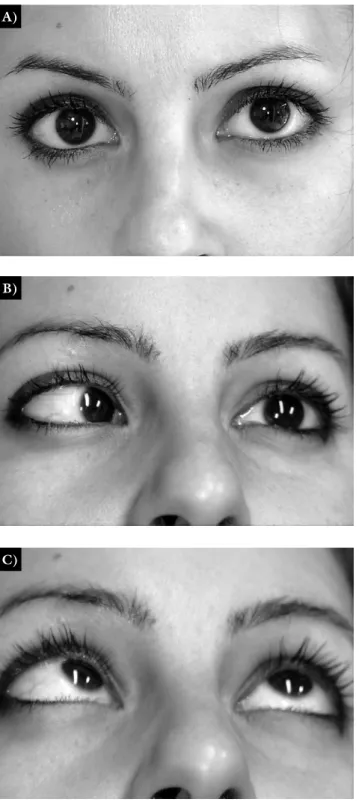 1. ábra A) A páciens szemei előretekintéskor. B) és C) Balra és balra  felfelé tekintéskor a bal szem abdukciója elmarad