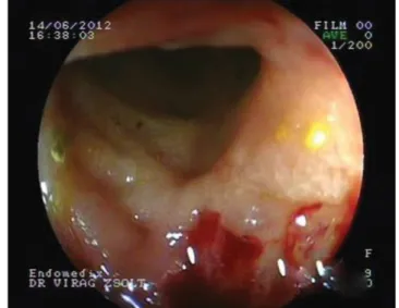 4. ábra A Crohn-terápia beállítása után fél évvel látott kolonoszkópiás  kép: a gyulladás remisszióban