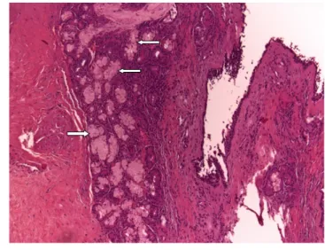 2. ábra Részben csillószőrös hengerhámmal, részben éretlen, illetve  érett laphám-metaplasiás hámmal (fehér nyíl) borított fibroticus  könnytömlőfal részlete