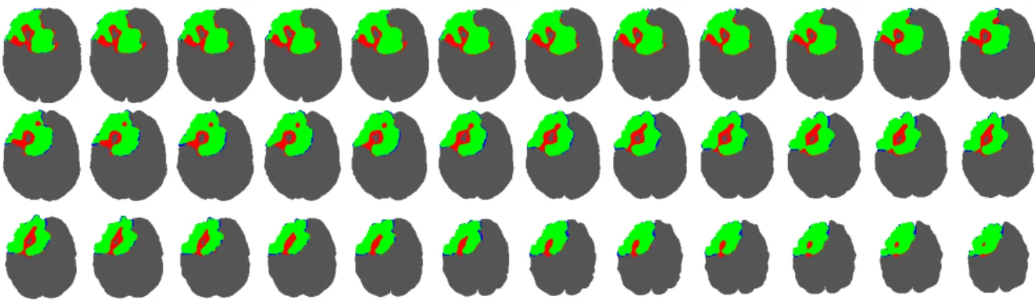 Fig. 9. Thirty-six consecutive slices from an identified tumor. Green pixels represent true positives, blue and red ones stand for false positives and false negatives, respectively
