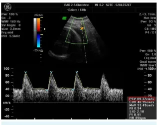 FIGurE 1. Measurement of uterine artery peak systolic velocity  (AutPSV) taken from the sagittal section of the uterus with  color flow mapping and applied pulsed wave Doppler