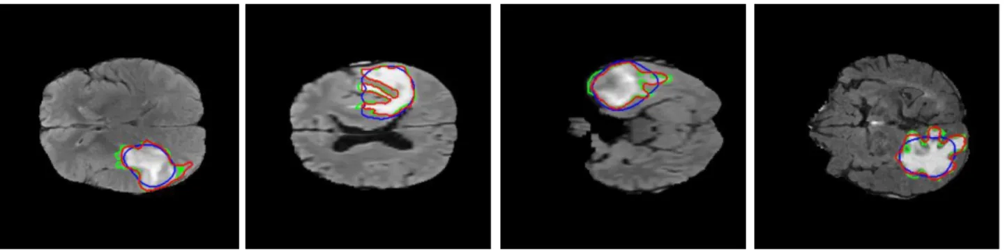 Fig. 1. Tumor contour detection using the Chan-Vese method; blue is the thresholded, binary tumor estimation of the color-spatial  saliency map, red is the improved result of the active contour step, green is the ground truth tumor outline