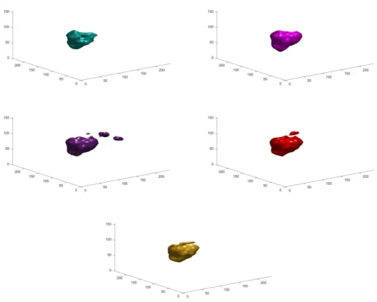 Fig. 3. 3D representation of a brain tumor with the different approaches; row 1: Proposed (turquoise) and Proposed + U-Net  (magenta); row 2: U-Net (purple) and WT-Net (red); row 3: Ground Truth with yellow
