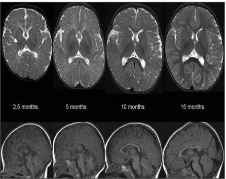 6. ábra: A normál mielinizáció alakulása MR képeken 