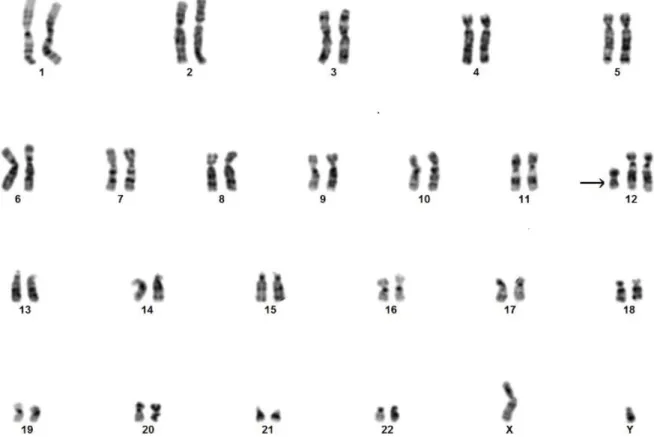 1. ábra A magzatvízvizsgálat során tenyésztett magzatvízsejtek G-sávos kromoszómapreparátumából készült kromoszómakép (karyotypus)