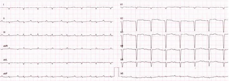 A később megszerzett második EKG-n (2. ábra)  még nincsen PQ-megnyúlás, de az alacsony kilengések  már megjelentek az inferior elvezetésekben, és a V1–
