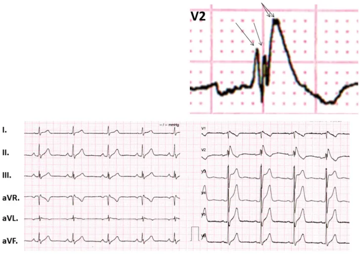1. ábra 12 elvezetéses EKG. A V1–2-elvezetés a jobb-Tawara-szár-blokk mellett az elevált J-pontból induló deszcendáló ST-szakaszt (coved ST-eleváció) és  negatív T-hullámot mutat