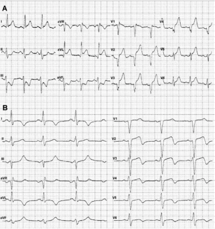 1. ábra A: Mellkasi fájdalom alatt, az első észleléskor készített EKG. B: Coronariaintervenció után készített 12 elvezetéses EKG