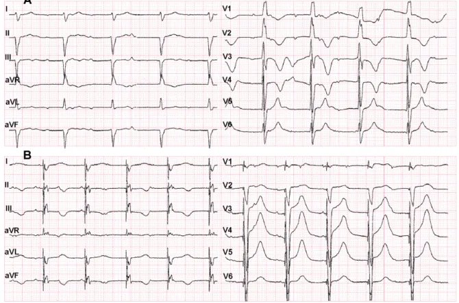 3. ábra A) Pacemaker-behelyezés előtti EKG a pitvar-kamrai disszociációval és megnyúlt QT-idővel