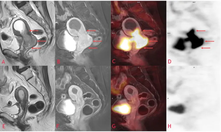 4. ábra Lokálisan előrehaladott méhnyakrák. Kiterjedt, húgyhólyagot infiltráló, hüvelyboltozatra és vaginára terjedő, az uterus alsó harmadát is érintő méh- méh-nyaktumor (piros nyilak) coronalis T2 MR- (A, E), posztkontrasztos T1 MR- (B, F), PET/MR (C, G)