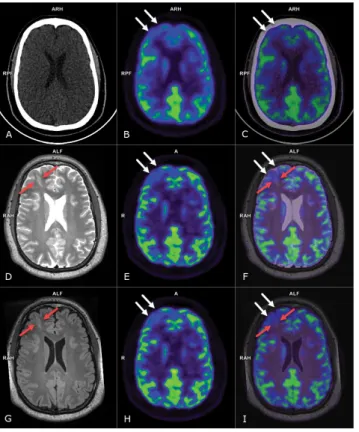 5. ábra Jobb frontalis FCD. Jobb oldalon frontalisan fokális corticalis  dysplasiára (FCD 2b) utaló szabálytalan elmosódott kontúrú  cortex látható az axialis T2 (D) és FLAIR (G) MR-, valamint  PET/MR (F, I) képeken, a FLAIR (G) MR- és PET/MR (I)  képeken 