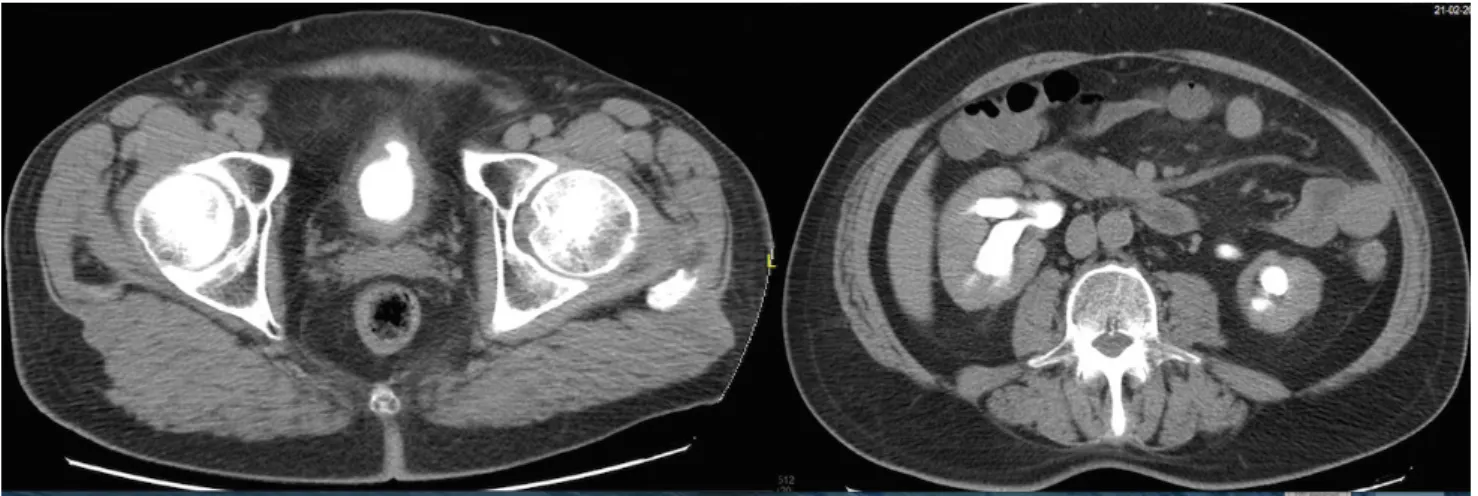 8. ábra Besugárzást követő CT-képek a megvastagodott hólyagfallal, a diverticulummal és a veseüregrendszeri tágulattal