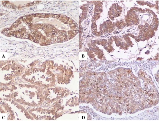 Figure 27.  Pro-SP-B immunoreactivity in adenocarcinomas of the lung with different growth  patterns